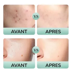 Avant après peau acnéique kit Tea Tree Salicylique