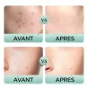 Avant après peau acnéique kit Tea Tree Salicylique